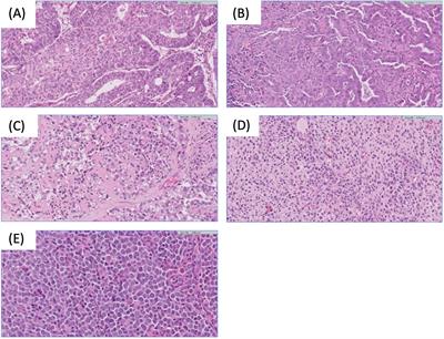 Single-cell RNA sequencing in endometrial cancer: exploring the epithelial cells and the microenvironment landscape